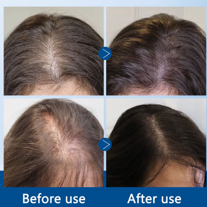 Everoraa Hairline recover serum